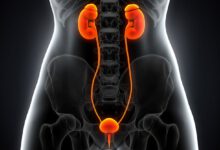 Photo of Comparison of Papillary Renal Cell Carcinoma Type 1 and Type 2: A Secondary Data Analysis