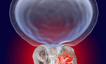 Photo of Nano-Particles Show Breakthrough Potential in Fighting Prostate Cancer